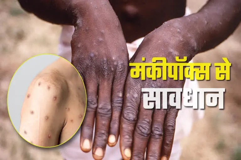 Monkeypox Alert : सावधान, दिल्ली में मंकीपॉक्स की एंट्री के बाद स्वास्थ्य विभाग ने जारी किया अलर्ट