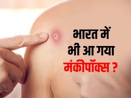 Monkeypox Alert