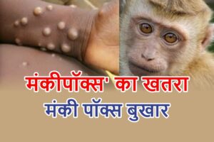 Monkeypox Alert